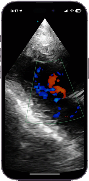 pocket ultrasound imaging