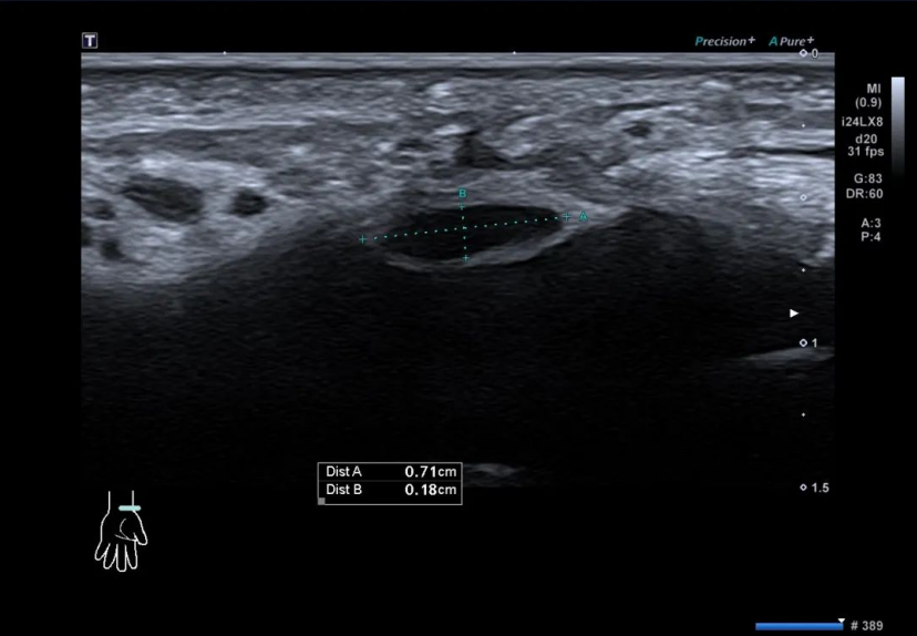 Thickened synovium in the flexor tendon sheath at the wrist key