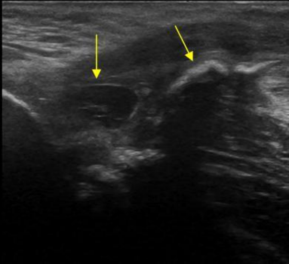 Ultrasound imaging of muscle strain