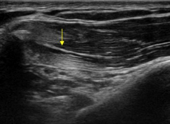 Ultrasound imaging of ligament strain