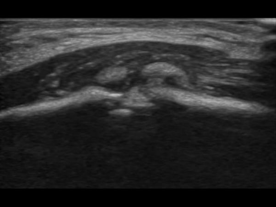 Fracture ultrasound imaging